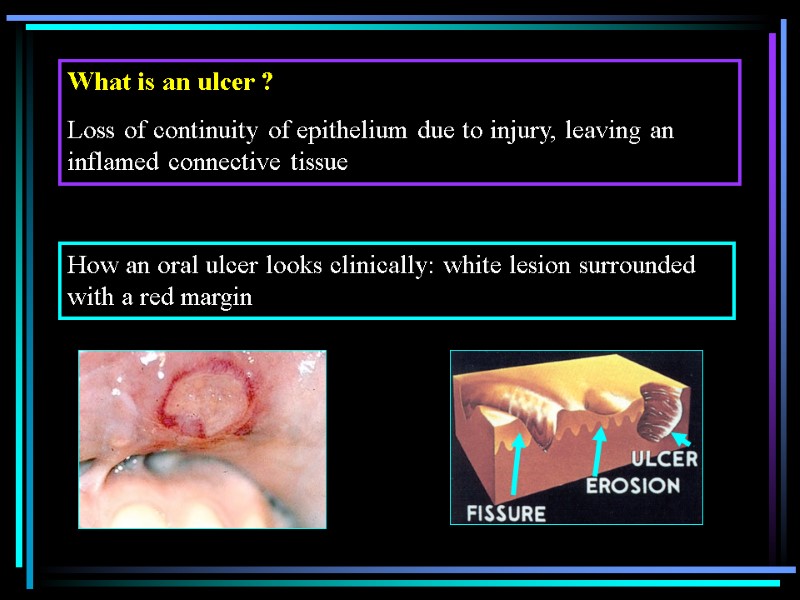 What is an ulcer ? Loss of continuity of epithelium due to injury, leaving